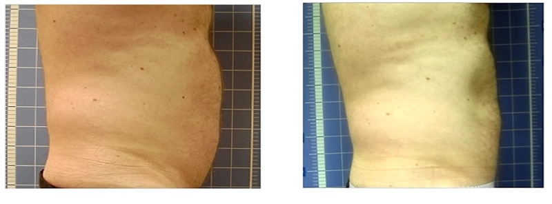 Lipo a Laser: redução comprovada de medidas e gorduras localizadas! O melhor tratamento para homens e mulheres por R$199